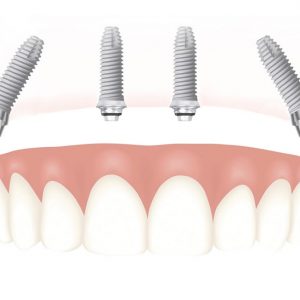 Implantes – Técnica All on 4